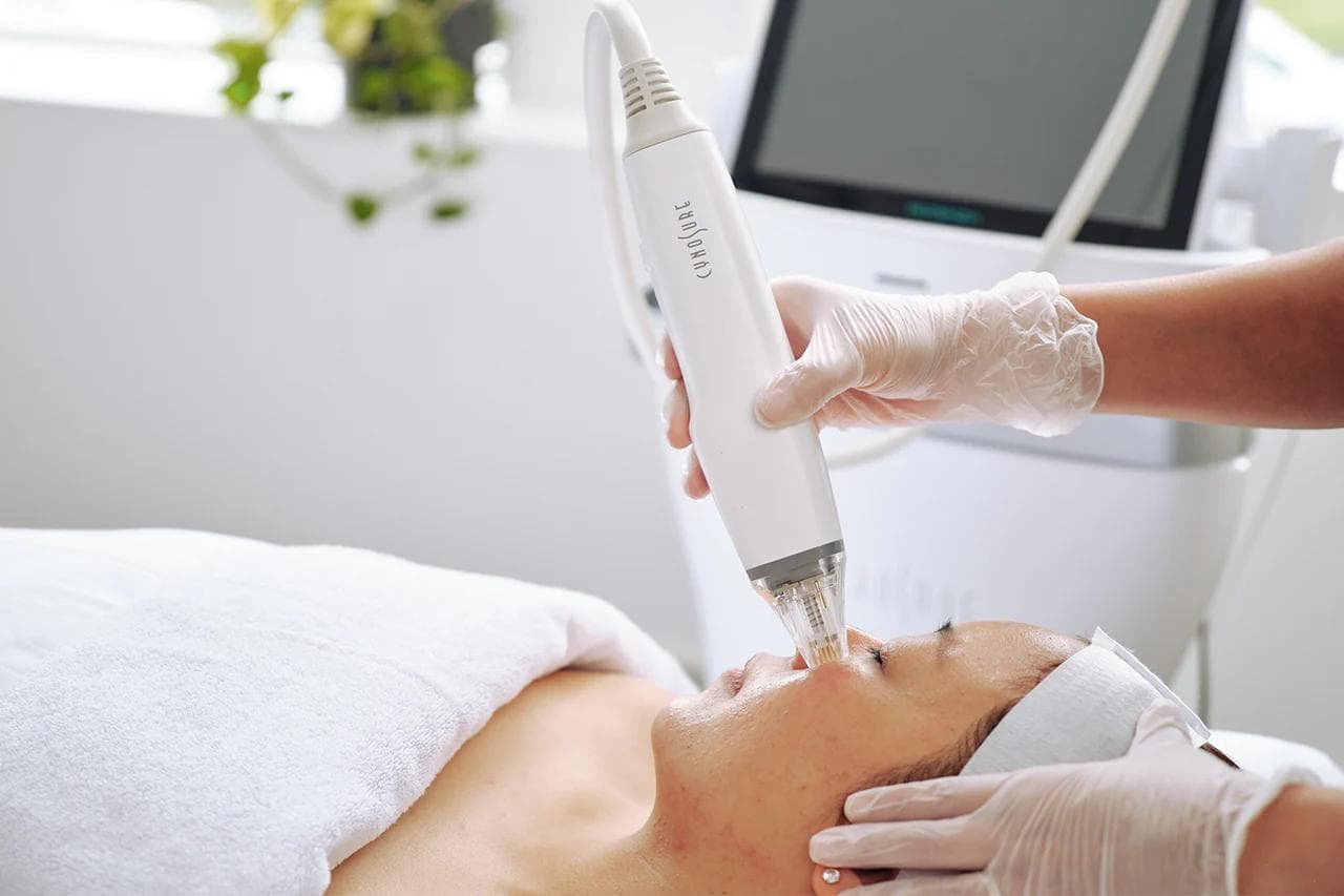 Potenza RF Microneedling treatment at Ardan Medspa